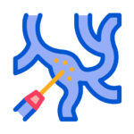 Varicose Vein Surgery (Laser)