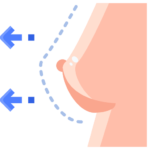 Breast Augmentation